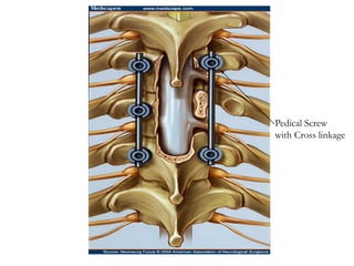 Pedical Screw
with Cross linkage
 