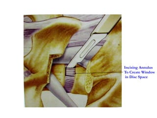 Incising Annulus
To Create Window
in Disc Space
 