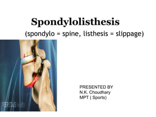 Spondylolisthesis
(spondylo = spine, listhesis = slippage)
PRESENTED BY
N.K. Choudhary
MPT ( Sports)
 