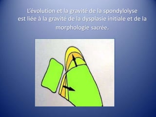 L’évolution et la gravité de la spondylolyse
est liée à la gravité de la dysplasie initiale et de la
morphologie sacrée.
 