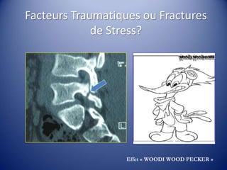 Facteurs Traumatiques ou Fractures
de Stress?
Effet « WOODI WOOD PECKER »
 