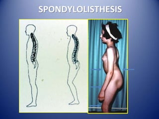 SPONDYLOLISTHESIS
 