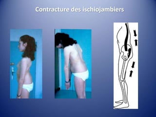 Contracture des ischiojambiers
 