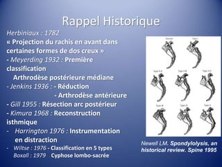 Rappel Historique
Herbiniaux : 1782
« Projection du rachis en avant dans
certaines formes de dos creux »
- Meyerding 1932 : Première
classification
Arthrodèse postérieure médiane
- Jenkins 1936 : - Réduction
- Arthrodèse antérieure
- Gill 1955 : Résection arc postérieur
- Kimura 1968 : Reconstruction
isthmique
- Harrington 1976 : Instrumentation
en distraction
- Wiltse : 1976 - Classification en 5 types
Boxall : 1979 Cyphose lombo-sacrée
Newell LM. Spondylolysis, an
historical review. Spine 1995
 