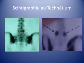 Scintigraphie au Technétium
 