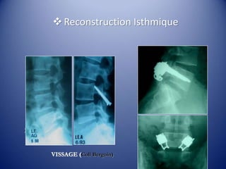 Reconstruction Isthmique
VISSAGE (Coll Bergoin)
)
 
