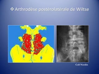 Arthrodèse postérolatérale de Wiltse
Coll Nordin
 