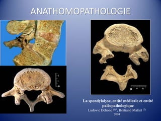 ANATHOMOPATHOLOGIE
La spondylolyse, entité médicale et entité
paléopathologique
Ludovic Debono (1)*, Bertrand Mafart (2)
2004
 