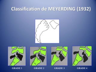 Classification de MEYERDING (1932)
GRADE 1 GRADE 2 GRADE 4GRADE 3
 