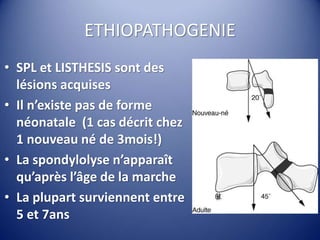 ETHIOPATHOGENIE
• SPL et LISTHESIS sont des
lésions acquises
• Il n’existe pas de forme
néonatale (1 cas décrit chez
1 nouveau né de 3mois!)
• La spondylolyse n’apparaît
qu’après l’âge de la marche
• La plupart surviennent entre
5 et 7ans
 