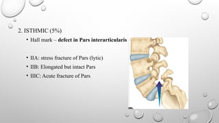 Pars Defect Cartoon spondylolysthesis of spine topic presentation | PPTX