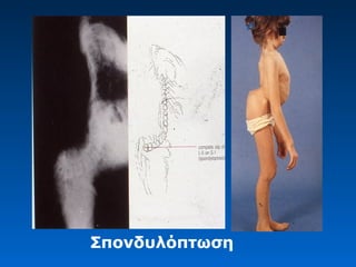 Σπονδυλόπτωση
 