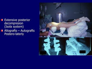 Extensive posterior
decompresion
(Isola system)
Allografts – Autografts
Postero-laterly
 