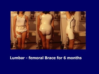 Lumbar - femoral Brace for 6 months
 