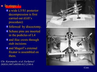 In stage 1
a wide L5/S1 posterior
decompression is first
carried out (Gill’s
procedure)
followed by discectomy.
Schanz pins are inserted
in the pedicles of L4
and iliac crests through
stab incisions
and Magerl’s external
fixator is assembled on
them.
Chr. Karampalis, et al, EurSpineJ
DOI10.1007/s00586-012-2190-6
Cont.
 