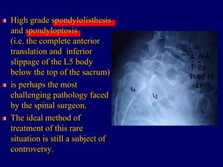 High grade spondylolisthesis
and spondyloptosis
(i.e. the complete anterior
translation and inferior
slippage of the L5 body
below the top of the sacrum)
is perhaps the most
challenging pathology faced
by the spinal surgeon.
The ideal method of
treatment of this rare
situation is still a subject of
controversy.
 