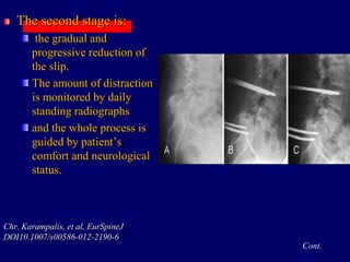 The second stage is:
the gradual and
progressive reduction of
the slip.
The amount of distraction
is monitored by daily
standing radiographs
and the whole process is
guided by patient’s
comfort and neurological
status.
Chr. Karampalis, et al, EurSpineJ
DOI10.1007/s00586-012-2190-6
Cont.
 