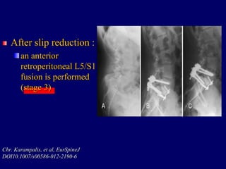 After slip reduction :
an anterior
retroperitoneal L5/S1
fusion is performed
(stage 3)
Chr. Karampalis, et al, EurSpineJ
DOI10.1007/s00586-012-2190-6
 