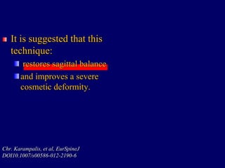 It is suggested that this
technique:
restores sagittal balance
and improves a severe
cosmetic deformity.
Chr. Karampalis, et al, EurSpineJ
DOI10.1007/s00586-012-2190-6
 