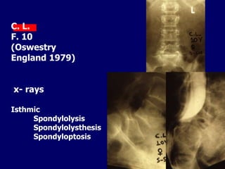 C. L.
F. 10
(Oswestry
England 1979)
x- rays
Isthmic
Spondylolysis
Spondylolysthesis
Spondyloptosis
 