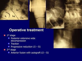 Operative treatment
1st stage
Posterior extensive wide
decompression
Traction
Progressive reduction L5 – S1
2nd stage
Anterior fusion with autograft L5 – S1
 