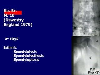 Ke. Br.
M. 10
(Oswestry
England 1979)
x- rays
Isthmic
Spondylolysis
Spondylolysthesis
Spondyloptosis
 
