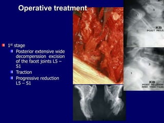 Operative treatment
1st stage
Posterior extensive wide
decomperssion excision
of the facet joints L5 –
S1
Traction
Progressive reduction
L5 – S1
 