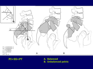 PI=SS+PT A. Balanced
B. Unbalanced pelvis
 