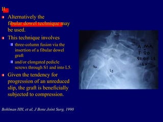 II.
Alternatively the
fibular dowel technique may
be used.
This technique involves
three-column fusion via the
insertion of a fibular dowel
graft
and/or elongated pedicle
screws through S1 and into L5.
Given the tendency for
progression of an unreduced
slip, the graft is beneficially
subjected to compression.
Bohlman HH, et al, J Bone Joint Surg, 1990
 