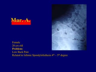 Mar. A.
Female
20 yrs old
Problem:
Low Back Pain
Related to Isthmic Spondylolisthesis 4th – 5th degree
 