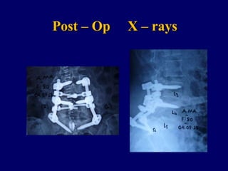 Post – Op X – rays
 