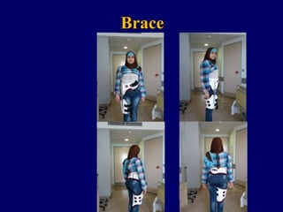 Brace
 