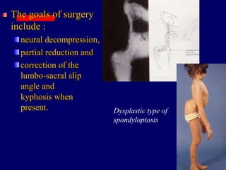 The goals of surgery
include :
neural decompression,
partial reduction and
correction of the
lumbo-sacral slip
angle and
kyphosis when
present. Dysplastic type of
spondyloptosis
 