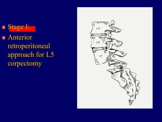 Stage I:
Anterior
retroperitoneal
approach for L5
corpectomy
 
