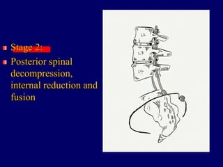Stage 2:
Posterior spinal
decompression,
internal reduction and
fusion
 