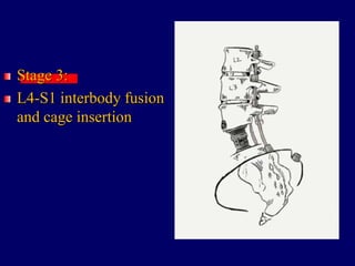 Stage 3:
L4-S1 interbody fusion
and cage insertion
 