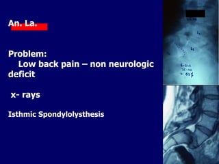 An. La.
Problem:
Low back pain – non neurologic
deficit
x- rays
Isthmic Spondylolysthesis
 