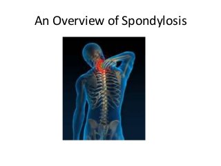 An Overview of Spondylosis
 