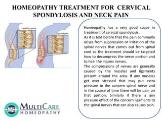 HOMEOPATHY TREATMENT FOR CERVICAL
SPONDYLOSIS AND NECK PAIN
Homeopathy has a very good scope in
treatment of cervical spondylosis.
As it is told before that the pain commonly
arises from suppression or irritation of the
spinal nerves that comes out from spinal
cord so the treatment should be targeted
how to decompress the nerve portion and
to heal the injures nerves.
The compressions of nerves are generally
caused by the muscles and ligaments
present around the area. If any muscles
get over stressed that may put extra
pressure to the concern spinal nerve and
in the course of time there will be pain on
that portion. Similarly if there is any
pressure effect of the concern ligaments to
the spinal nerves that can also causes pain.
 