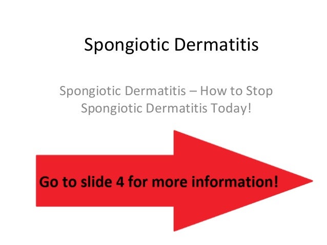 The Definitive Guide To Spongiotic Dermatitis And Lupus - kflfkbm