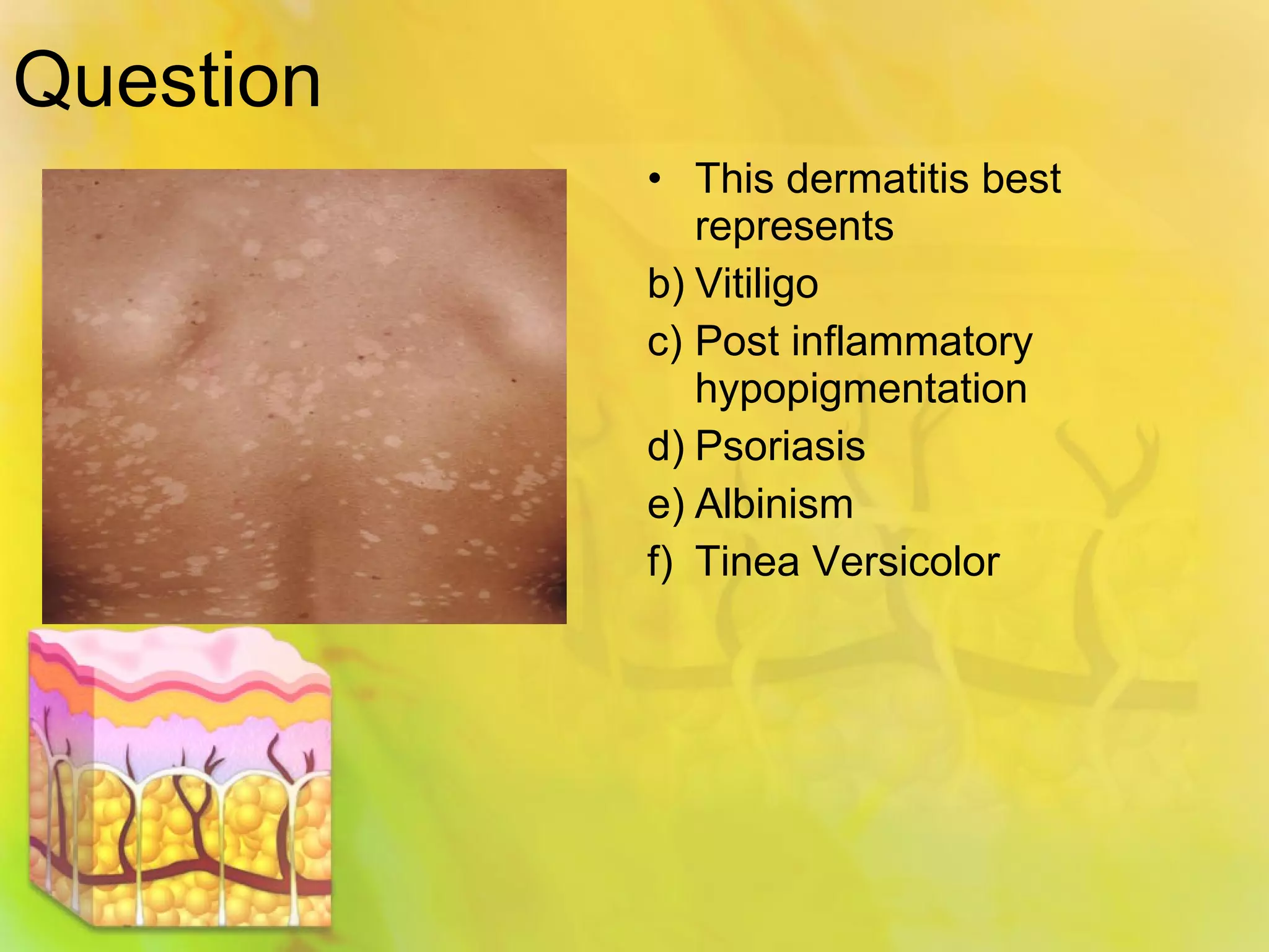 The Unexpected Link Between Spongiotic Dermatitis And Lupus - izp5mrl