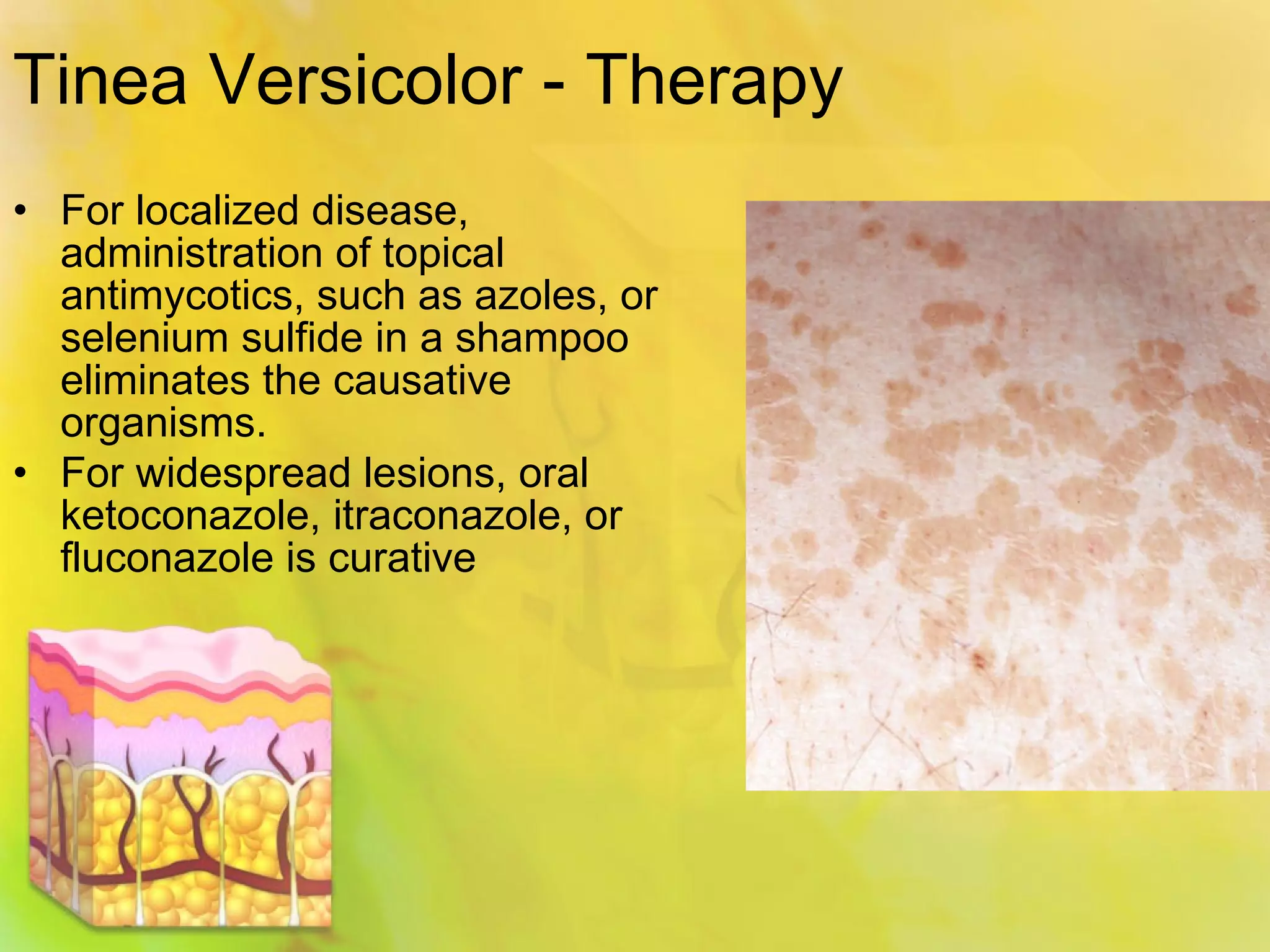 The Definitive Guide To Spongiotic Dermatitis And Lupus - q8t7rvo