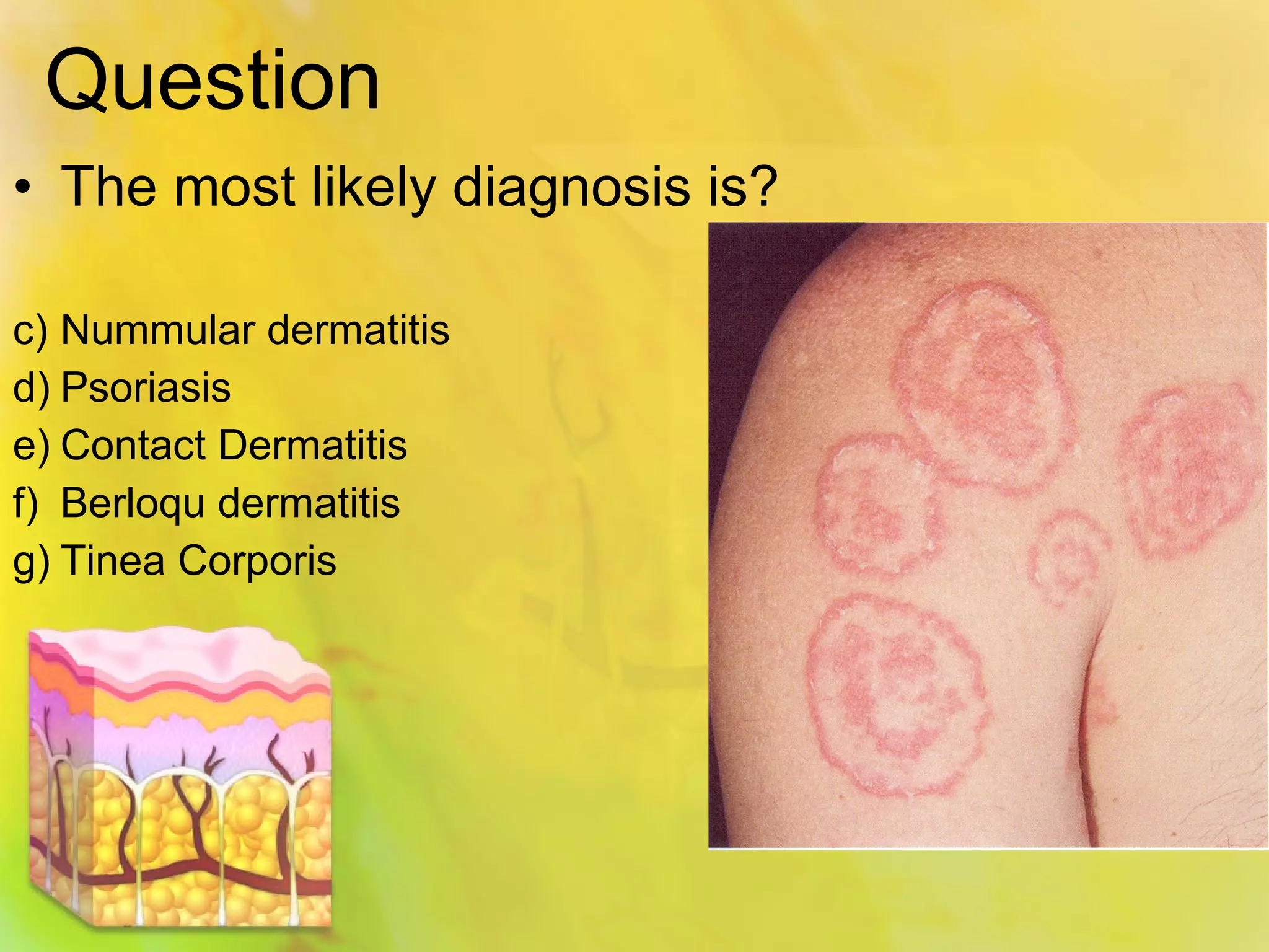 The Unexpected Link Between Spongiotic Dermatitis And Lupus - pathhdp