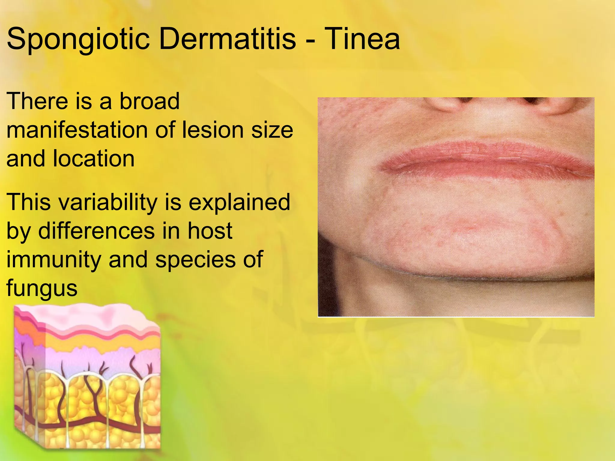 Spongiotic Dermatitis And Lupus: The Shocking Connection You Need To Know - fnbxdsq