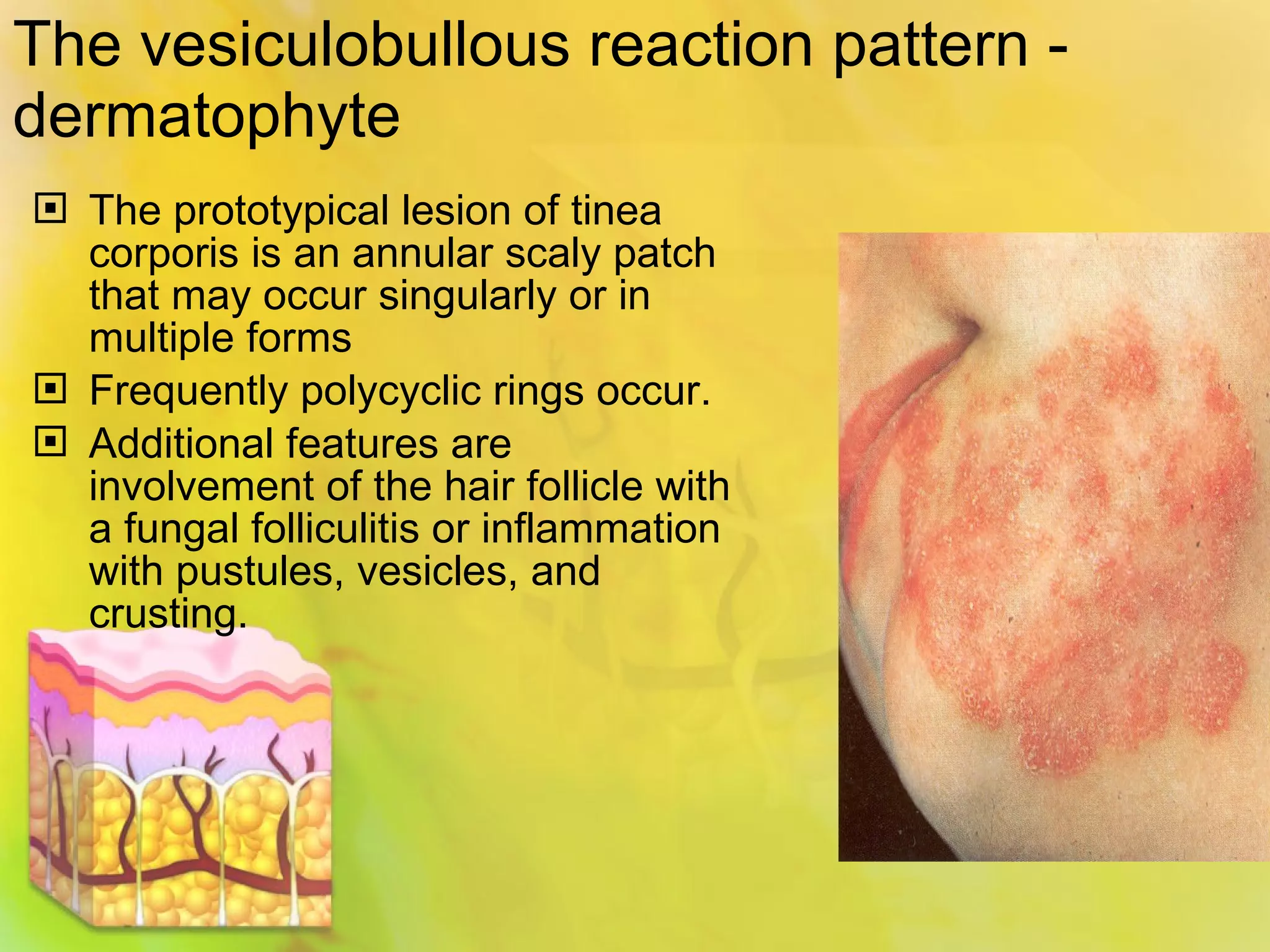 Is Your Spongiotic Dermatitis Hiding A Lupus Diagnosis? - vdm9zt4