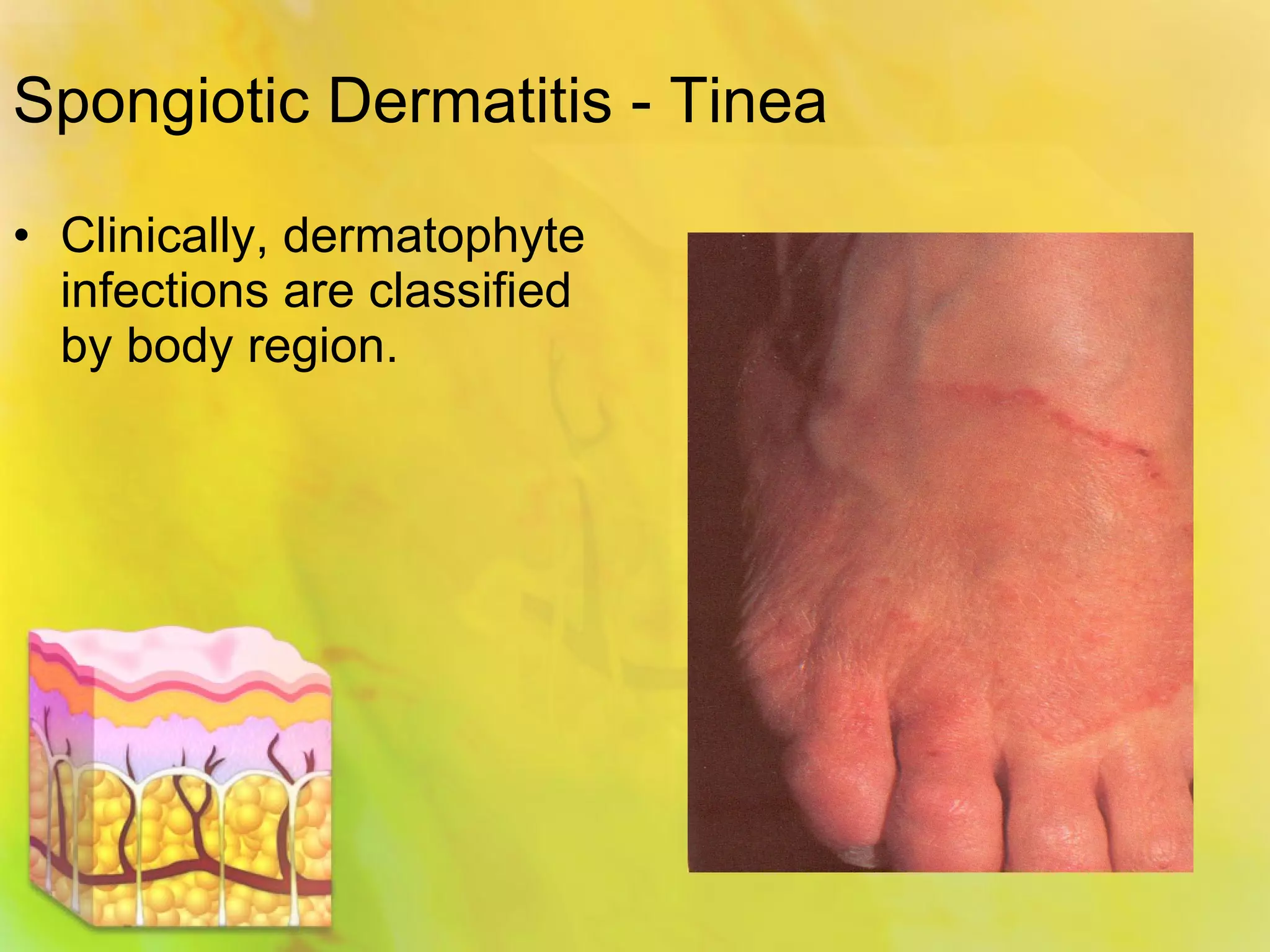 Is Your Spongiotic Dermatitis Hiding A Lupus Diagnosis? - b3mu7fe