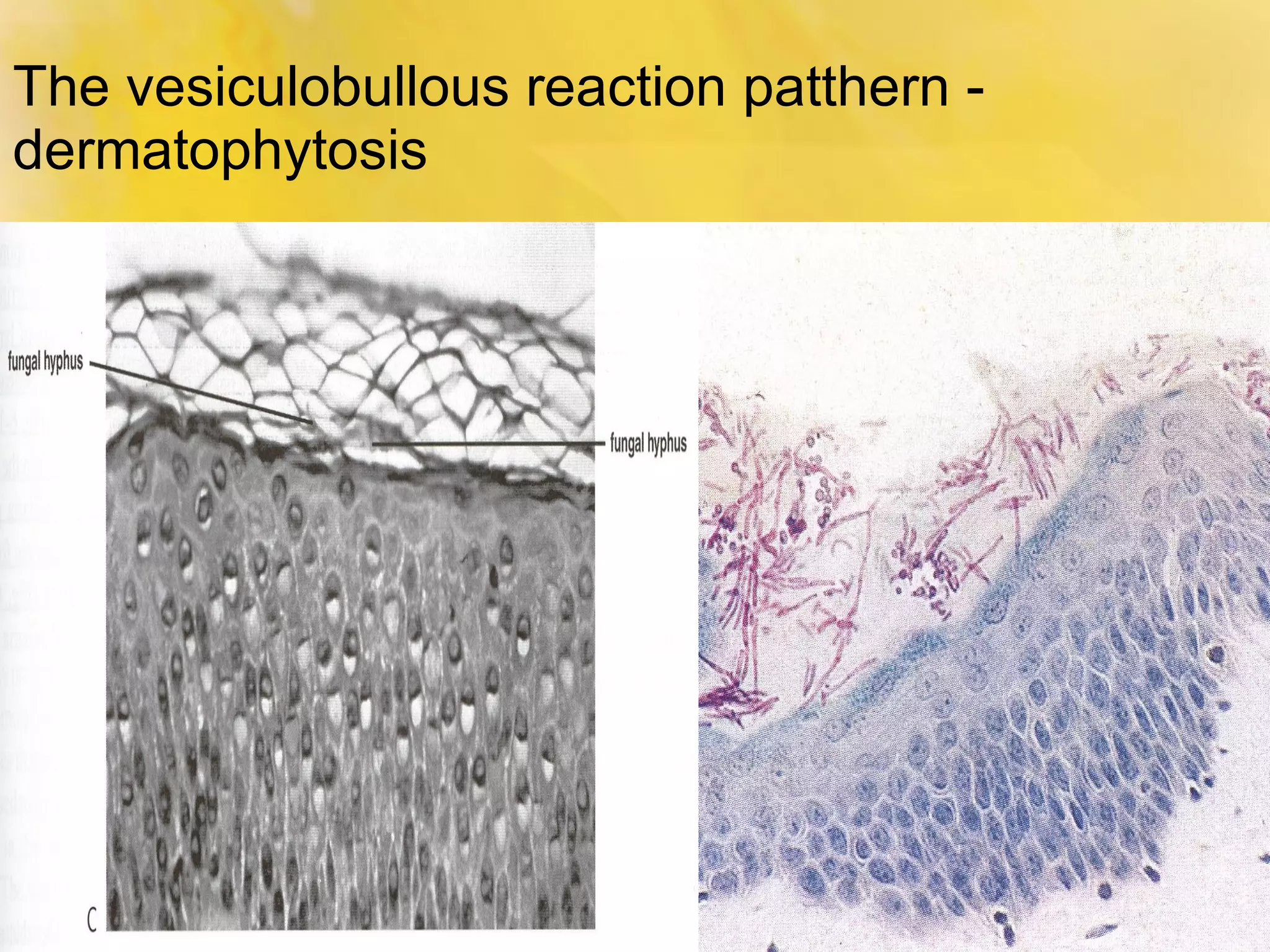 Lupus Misdiagnosed As Spongiotic Dermatitis: Are You At Risk? - hubj2yl