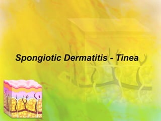 Spongiotic Dermatitis - Tinea 