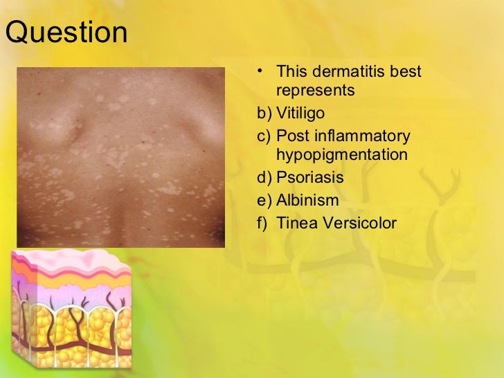 Spongiotic dermatitis tinea