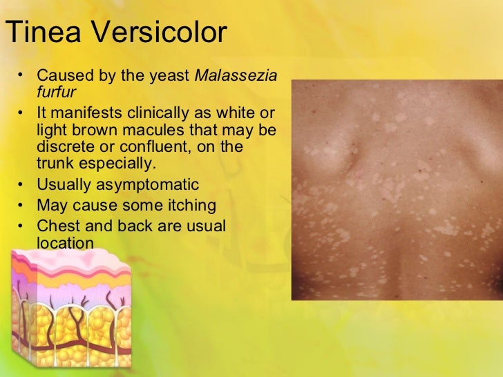best oral treatment for tinea versicolor